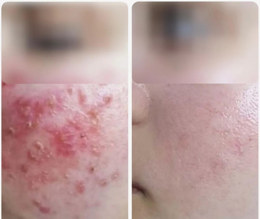 Acne treatment, before and after