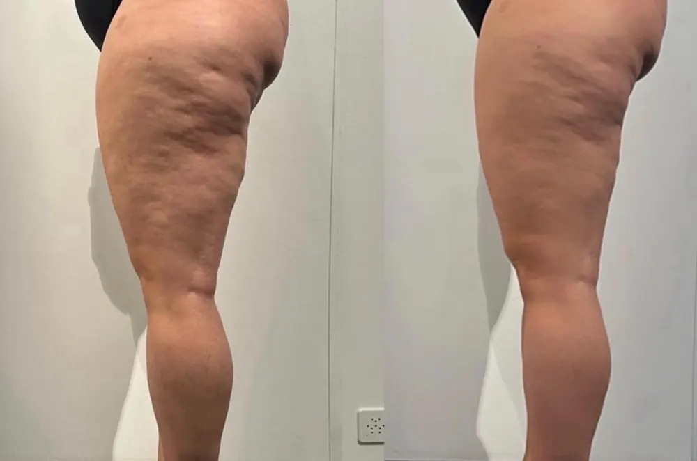 Cellulite, before and after