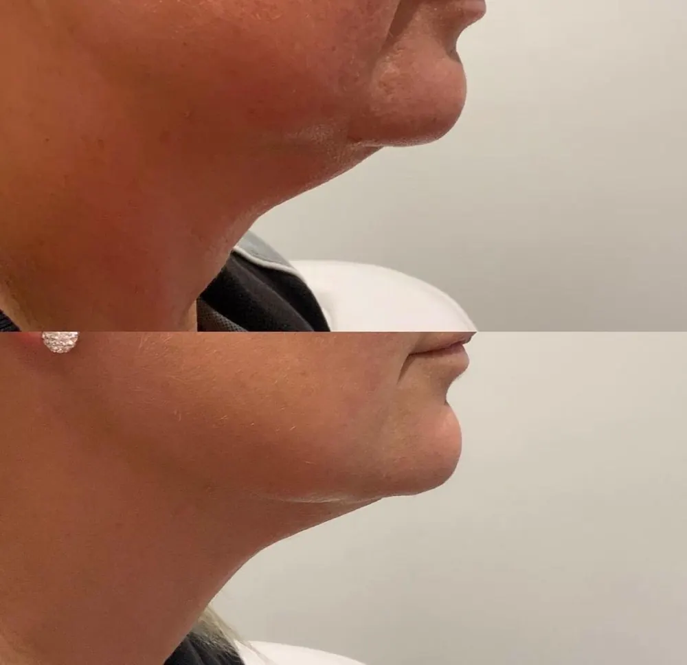Fotona DoubleChin, before and after