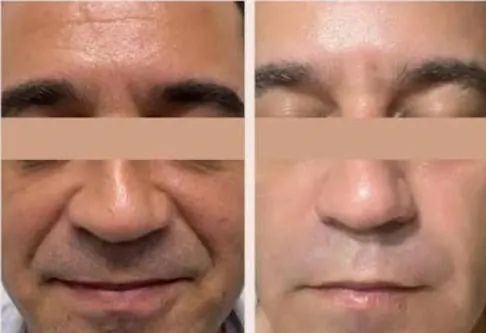 Fotona 4D, before and after