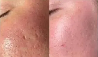 Fractional Fotona, before and after