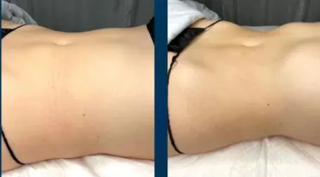 Lipocavitation, before and after