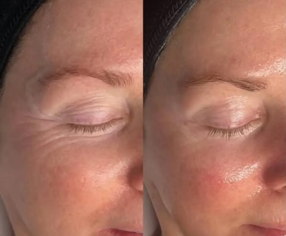 SmoothEye, before and after