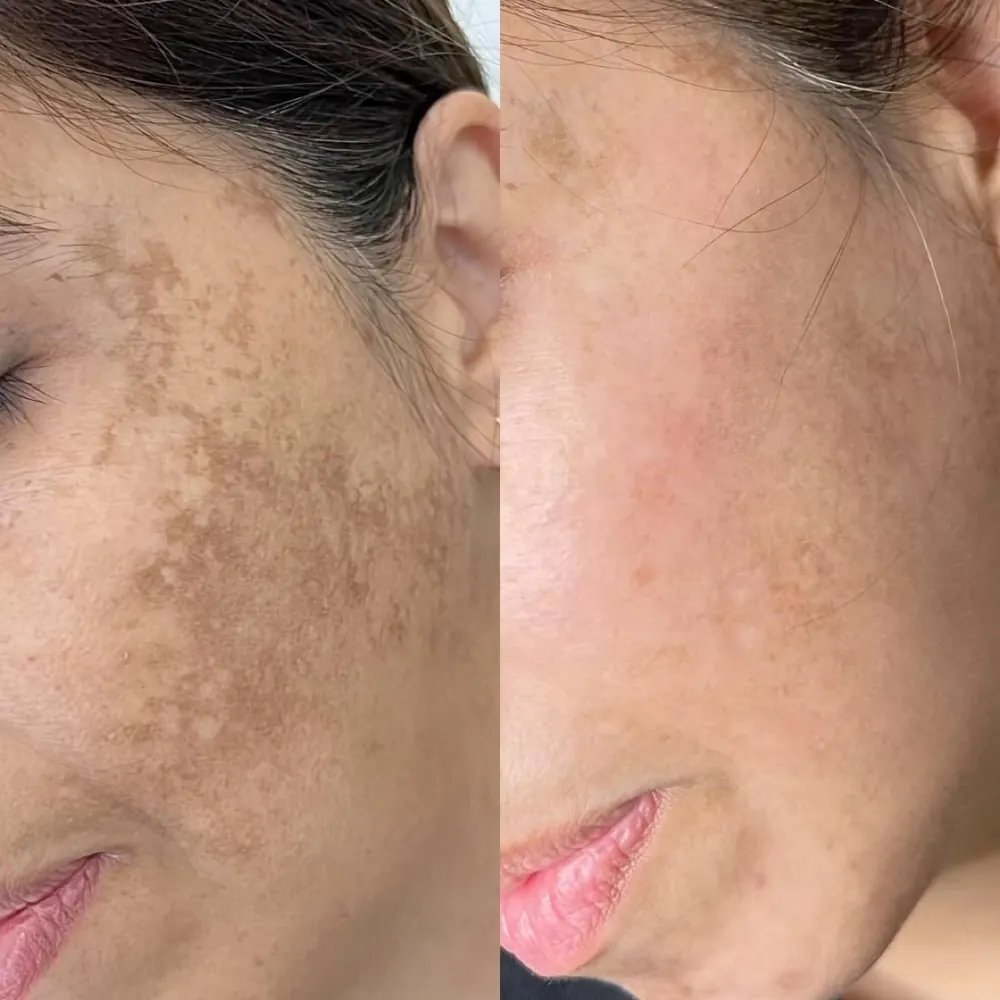 Dark spots, before and after