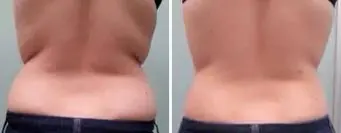 TightSculpting, before and after