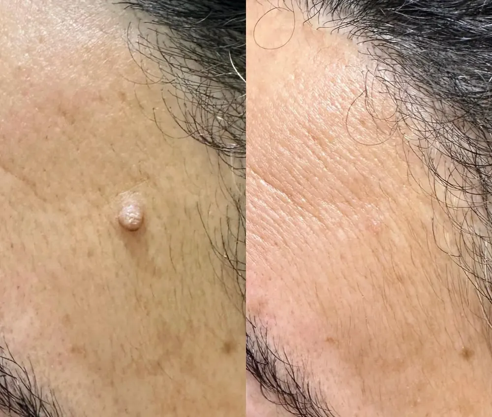 Wart removal, before and after