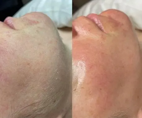 Dermaplaning, before and after