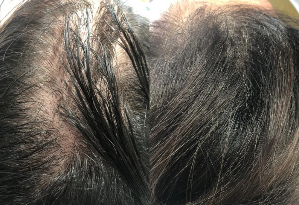 Autologous exosomes on the scalp, before and after