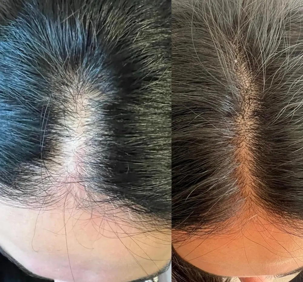 Autologous exosomes on the scalp, before and after