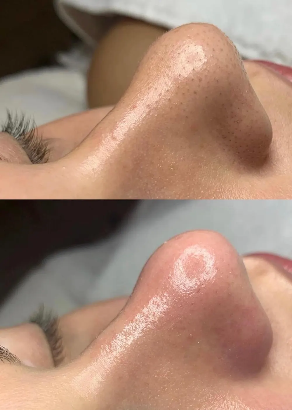 HydraFacial, before and after