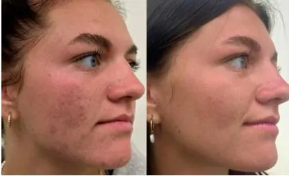 Microneedling, before and after