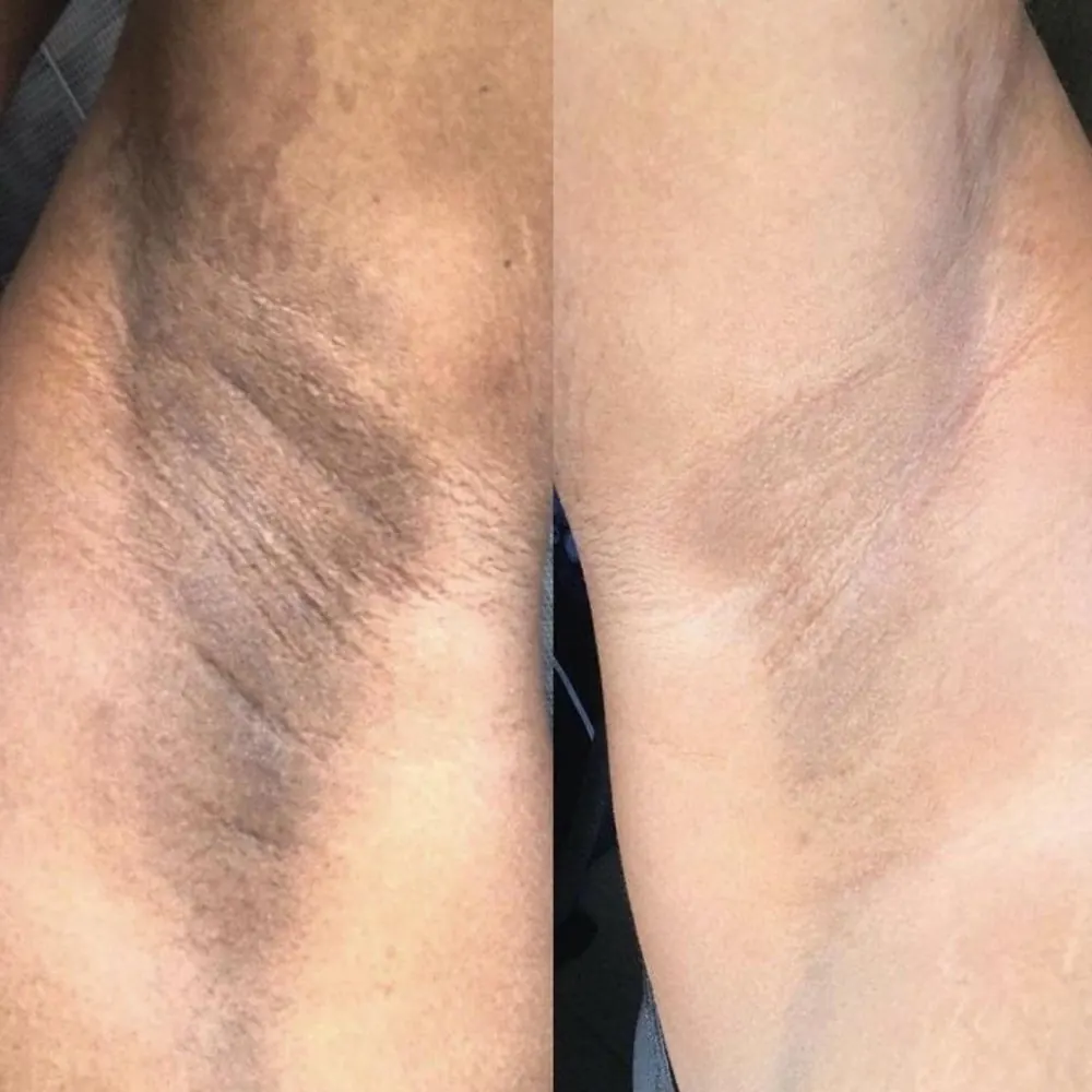 Chemical peeling, before and after