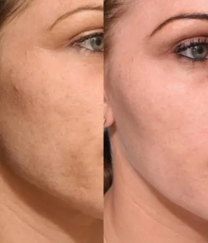 SkinBooster, before and after
