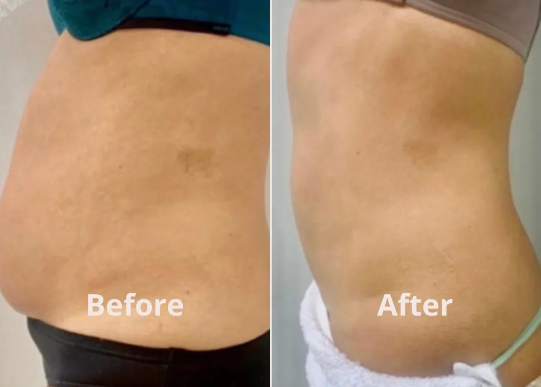 Lipocavitation, before and after