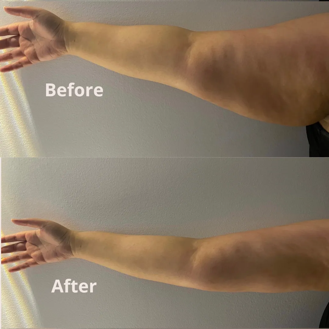 Lipocavitation, before and after