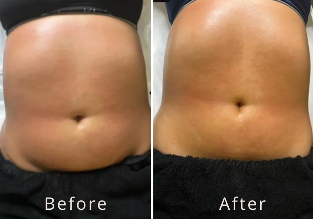 Lipocavitation, before and after