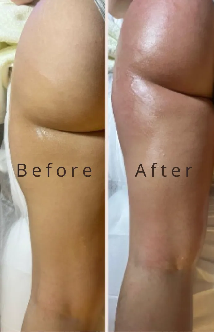 Lipocavitation, before and after
